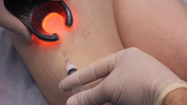 Склеротерапия при варикозе