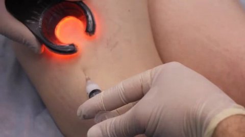 Склеротерапия при варикозе