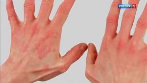 Холодовая аллергия (часть 1). Телеканал "Россия 1", "О самом главном"