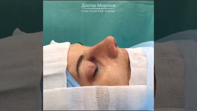 Первичная ринопластика #1