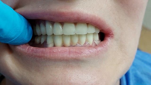 ПРОТЕЗ ТИШЛАР ! +79636579707 ВАТСАП смотреть онлайн