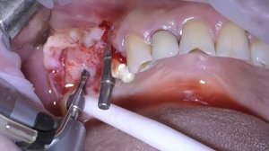 Anthogyr Axiom implant placement after sinus surgery and socket preservation