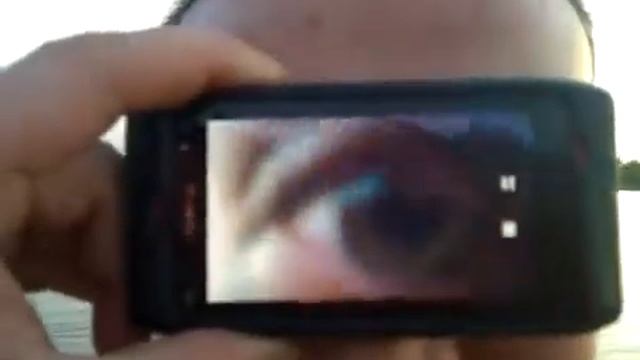 Лишился глаза из-за телефона. смотреть онлайн