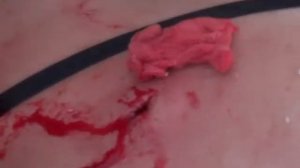 Хирургическое удаление атеромы в полевых условиях. 18+