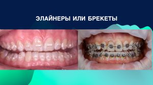 Элайнеры или брекеты?