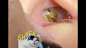 Earwax Removal.  Removes fungal earwax and cleans the ears (Ep.9)