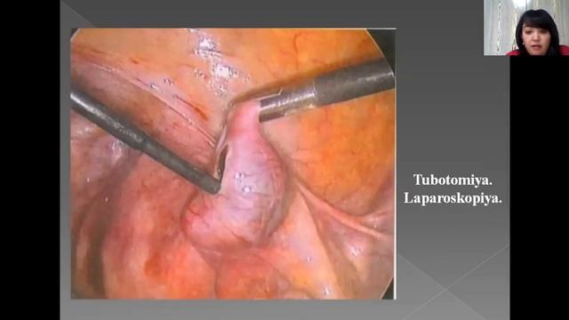 Ginekologiyada o’tkir qorin sindromi смотреть онлайн