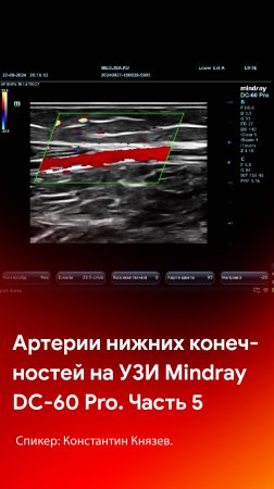 Сканирований артерий нижних конечностей высокоплотным датчиком на Mindray DC-60 Pro. Часть 5