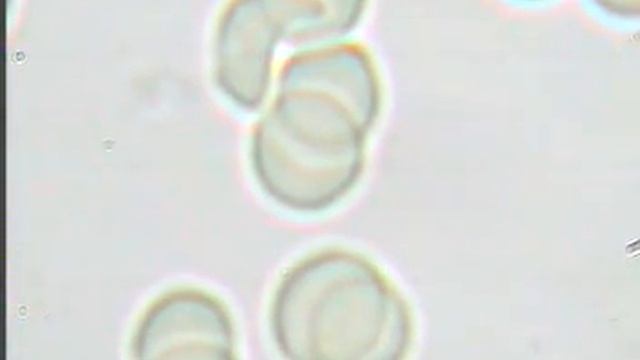Кровь под микроскопом после лечения. Гемосканирование. смотреть онлайн