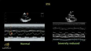 Focused cardiac ultrasound (FoCUS) for the Nephrologist: core pathologies | Dr. Koratala @NephroP