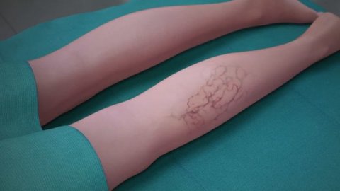 варикоз на ногах (лечение варикозной болезни нижних конечностей)