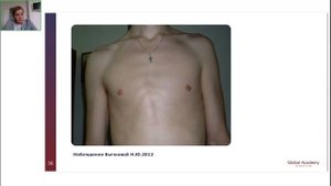 Дисплазия соединительной ткани: на что обращать внимание косметологу