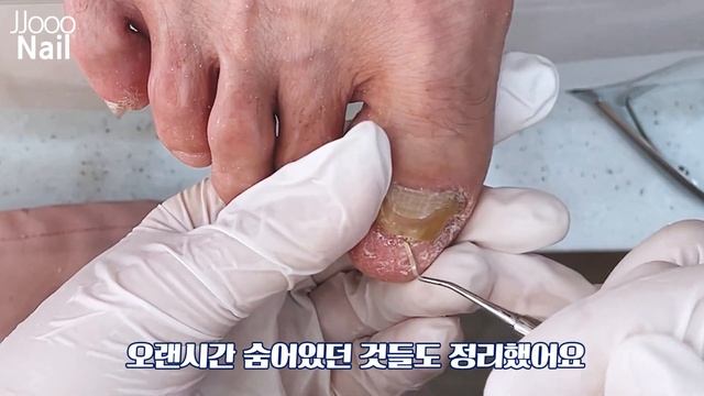 발톱깎이가 안 들어가요 / 두꺼워진 발톱 때문에 오신 할아버지 깨끗하게 진행해드렸어요 / 두꺼운 발톱 / 쭈네일 /