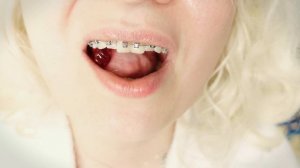 ASMR mukbang in braces - chewing and swallowing jelly teddybears