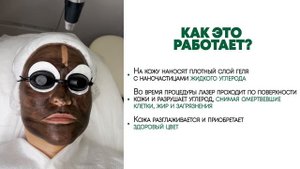 Карбоновый лазерный пилинг