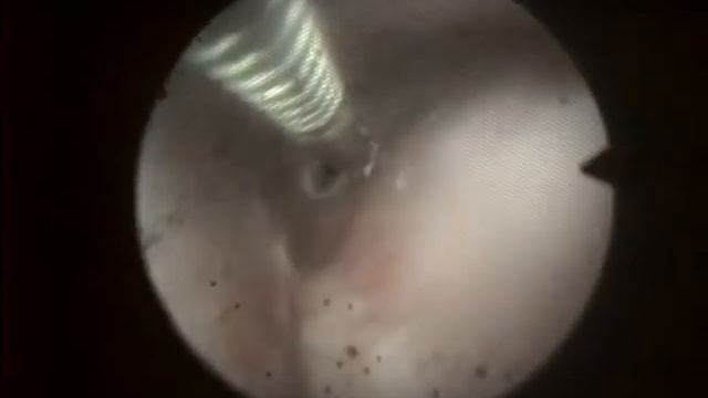 стриктура пищевода смотреть онлайн