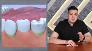 Пришеечный кариес: виды, лечение, профилактика