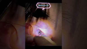 Earwax removal. Dry and hard earwax as rock.