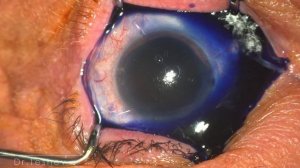 Аспирационный векорасширитель с стоматологический отсасыватель ГНОМ.