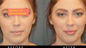 Филлеры B-esta | 2filler.ru