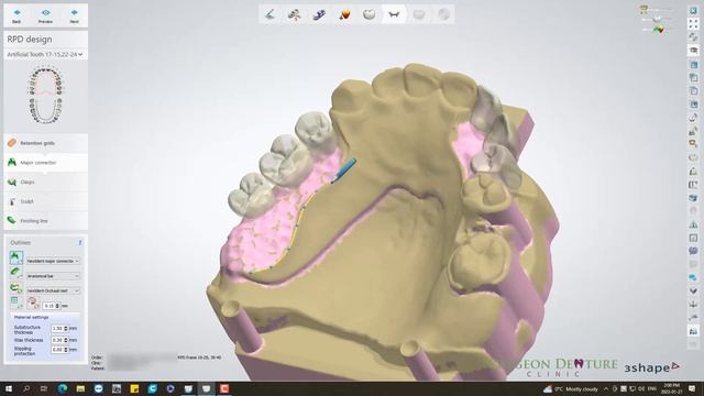 Cast Partial Upper and Lower Digital Designs