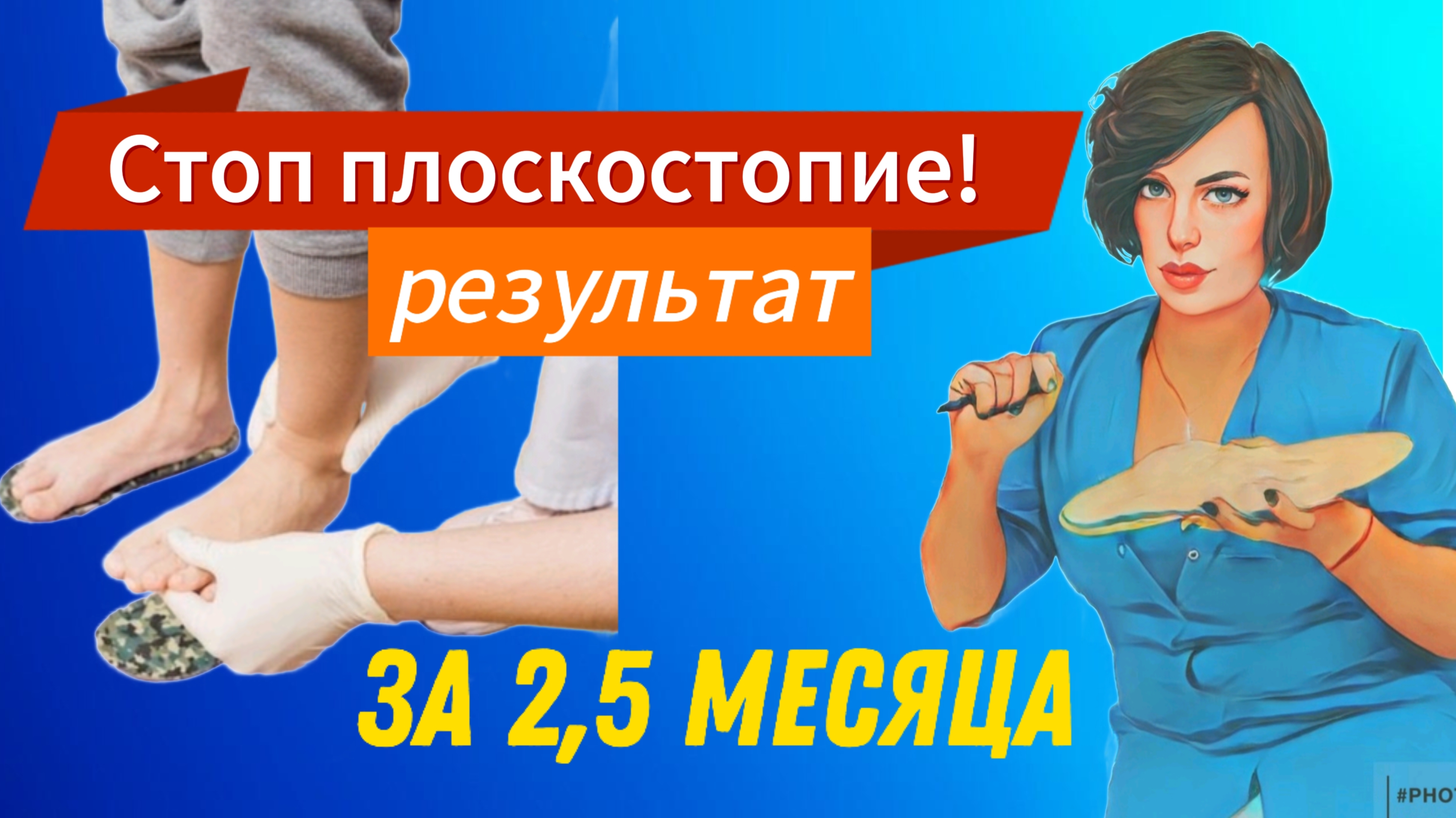 Результат работы с плоскостопием за 2,5 месяца! #плоскостопие #вальгус #ортопед