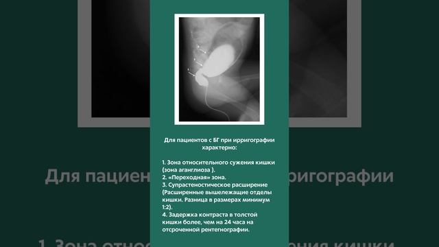 Ретген-диагностика Болезни Гиршпрунга смотреть онлайн