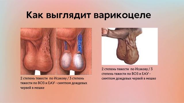 Варикоцеле у детей и взрослых | Классификация | Симптомы |Диагностика | Лечение | Лекции по урологии