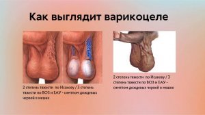 Варикоцеле у детей и взрослых | Классификация | Симптомы |Диагностика | Лечение | Лекции по урологии