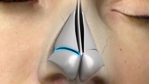 операция по устранению врожденных или приобретенных деформаций носа.