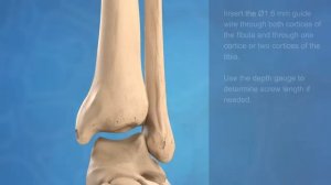 Фиксация ДМБС [get-save.com]