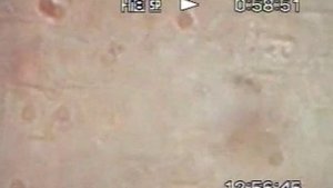 Биоптрон и клетки крови