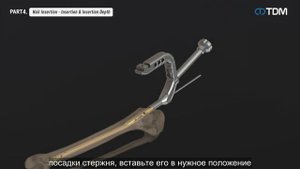 Штифт для большеберцовой кости [get-save.com]