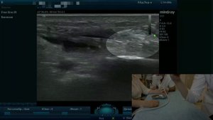 Введение бетаметазона при Декервена (тендовагинит) под контролем УЗИ