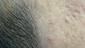 Loan Nguyen Acne Treatment 15422