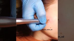 Лазерное удаление липомы на лице