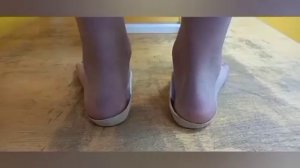 Коррекция вальгусной установки или деформации стопы.