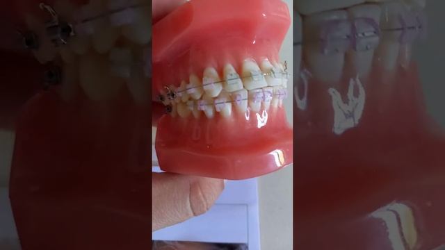 Breketlarni qanday turlari bor ?? смотреть онлайн