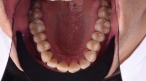HOW TO USE OCCLUSAL CONTRASTOR for Dental Photography (Black Line)