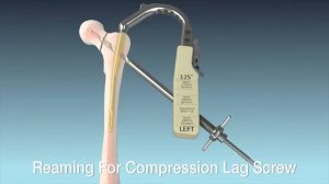 Гамма. Техника имплантации [get-save.com]