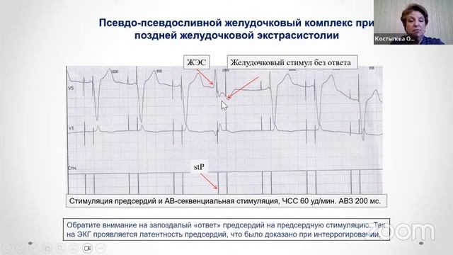Основы электрокардиостимуляции: мостик к пониманию работы имплантируемых устройств
