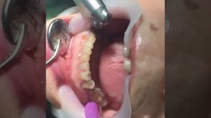 Лечение зуба с помощью лазера  #стоматология #лазер #зубы #пломбы #докторпиямов