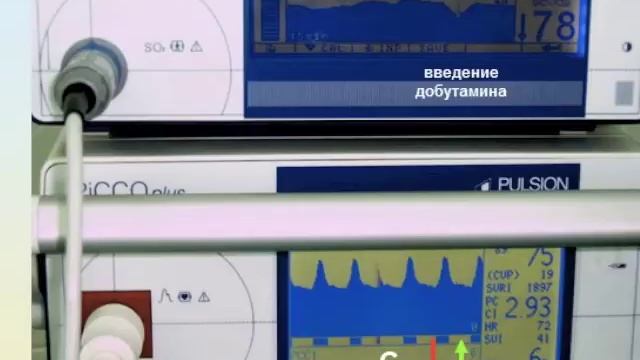 Мониторинг гемодинамики Кузьков В.В. (ч1)
