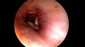 ГЛИСТ В УХЕ