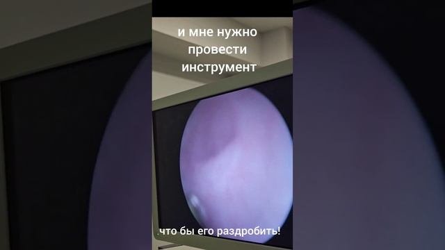 дробление камня мочеточника