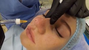 Коррекция носа 👃🏻