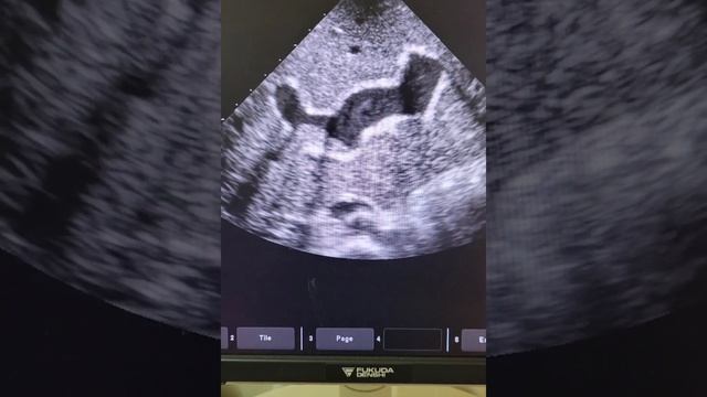 liver with PPF and RPPV thrombus смотреть онлайн