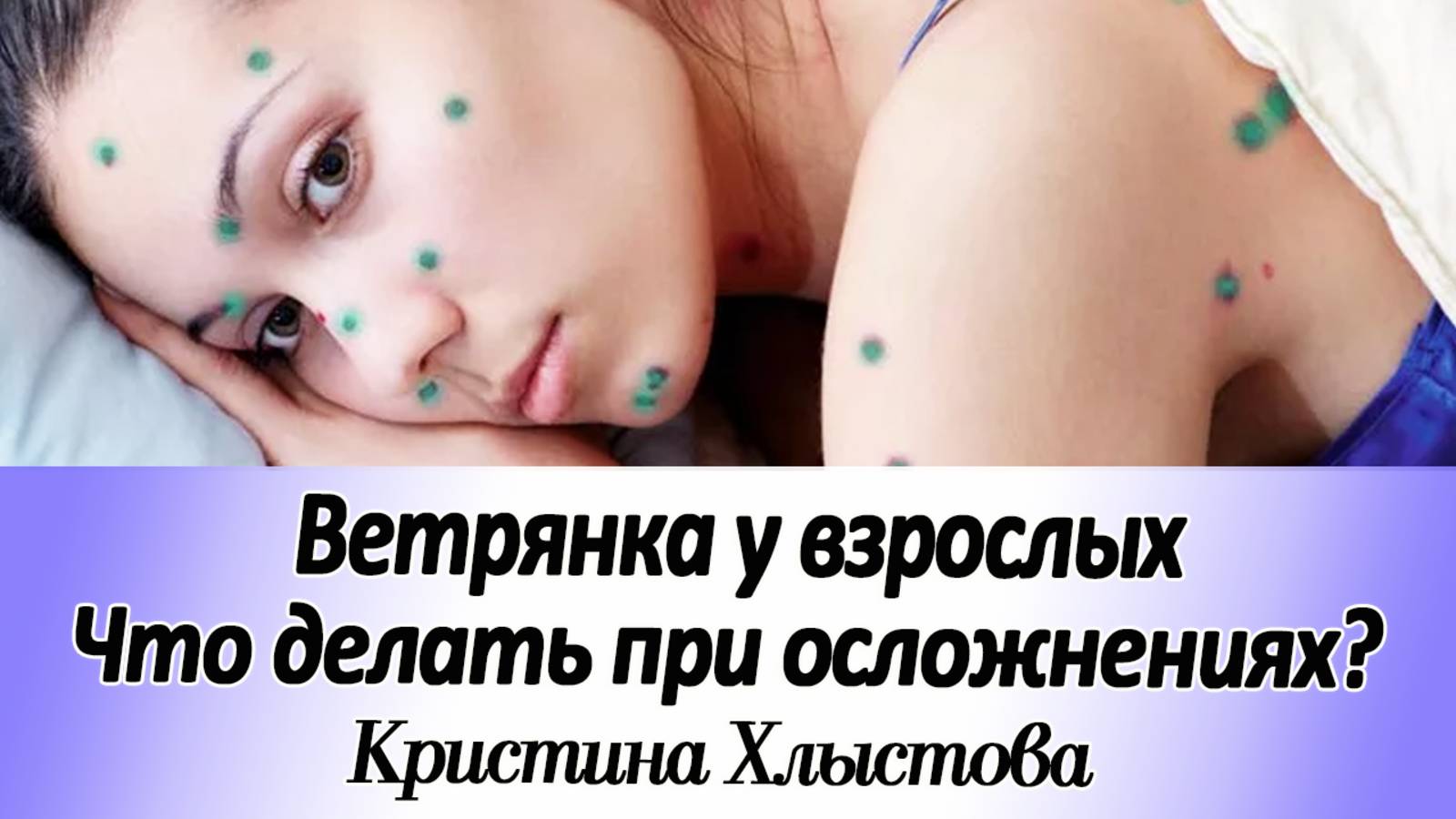 Как облегчить осложнения при ветрянке у взрослых | Кристина Хлыстова