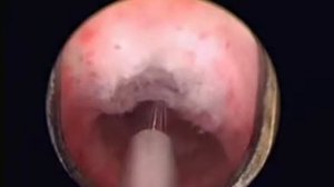 Dr. Kuntz уретротомия