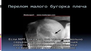 Перелом бугорка плечевой кости